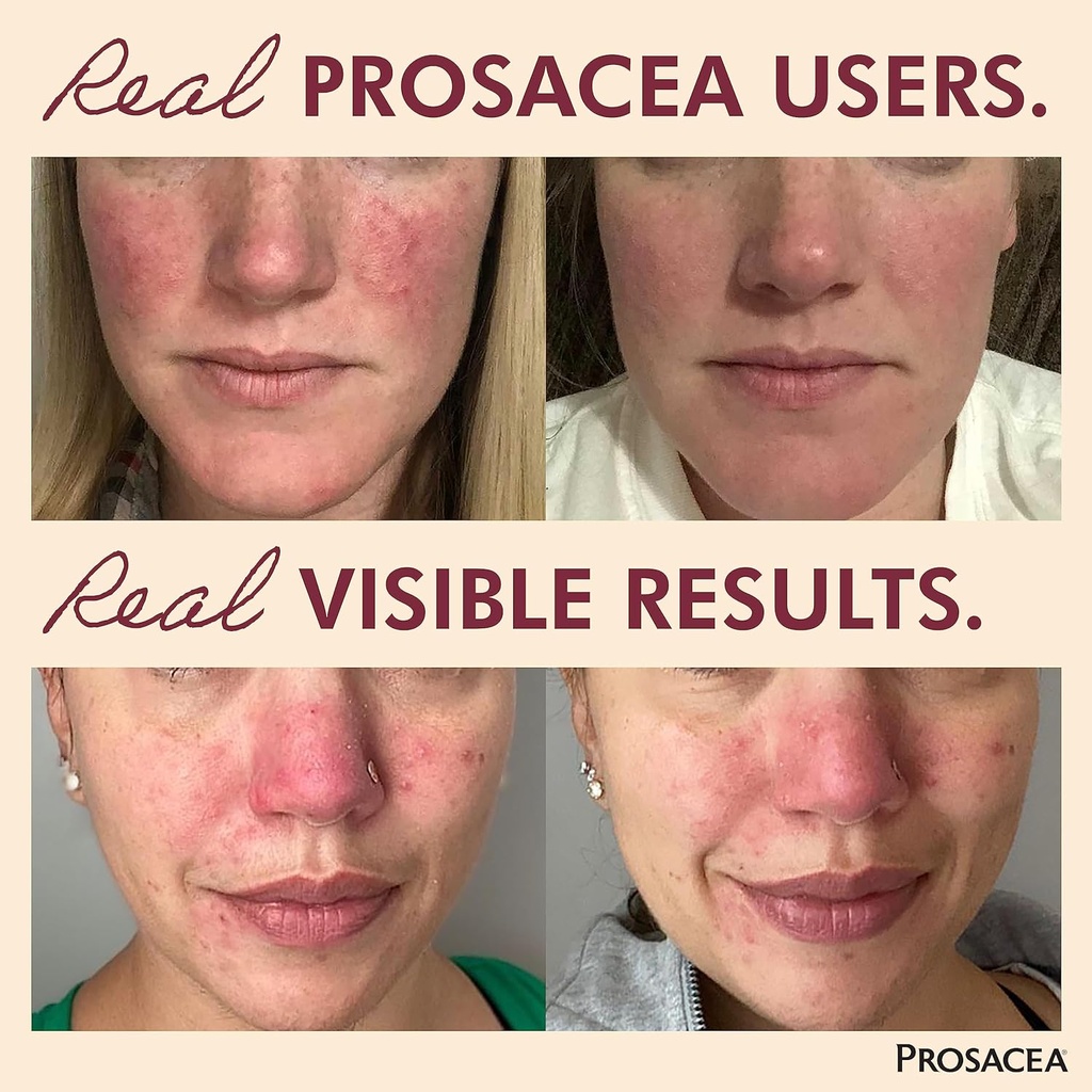 prosacea---medicated-rosacea-treatment-f-2.jpg