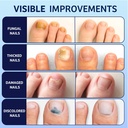 meoly-toenail-fungus-treatment-30-undecy-5.jpg