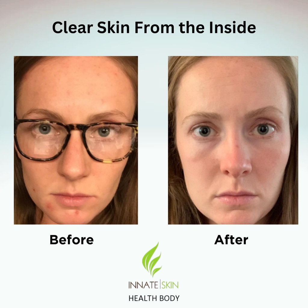 clear-skin-acne-vitamin-system-20-antiox-3.jpg