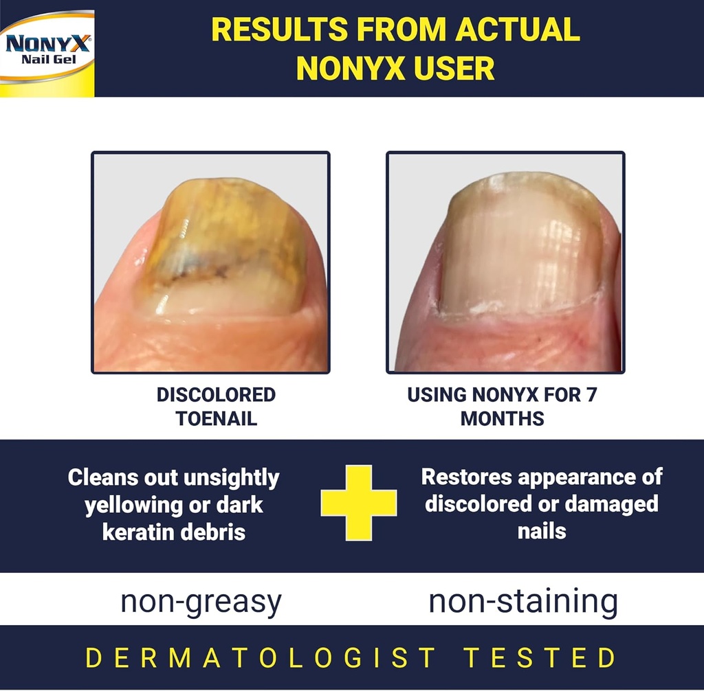 fungal-nail-clarifying-gel-clinically-pr-2.jpg