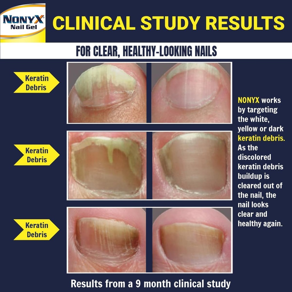 fungal-nail-clarifying-gel-clinically-pr-3.jpg