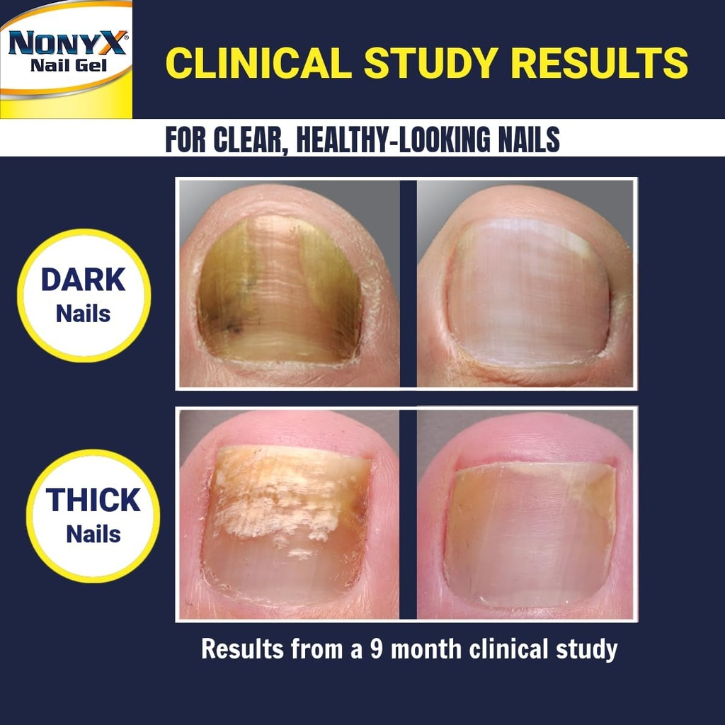 fungal-nail-clarifying-gel-clinically-pr-4.jpg