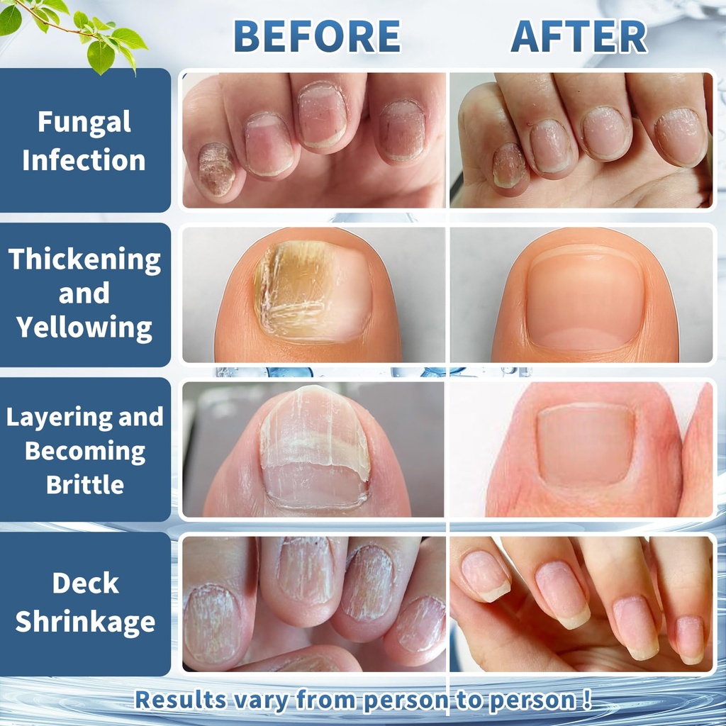 maximum-strength-nail-fungus-treatment-f-6.jpg